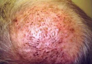bleeding after hair transplant surgery