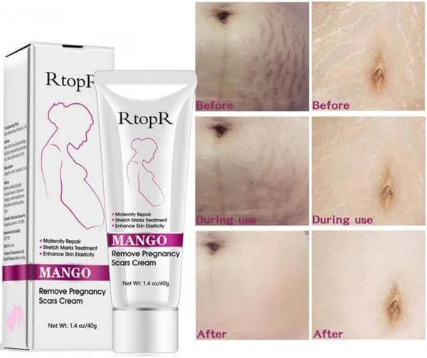 Rtopr Mango Remove Pregnancy Scars Cream & Stretch Marks Treatment Maternity Repair Anti-Aging Anti Winkle Firming Body Cream - Image 5