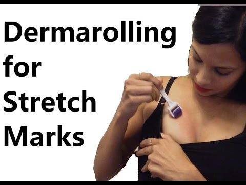 Derma roller for stretch marks