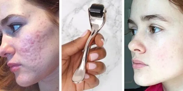 Derma roller for scars