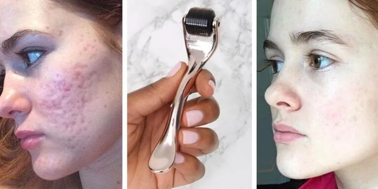 Derma roller for scars