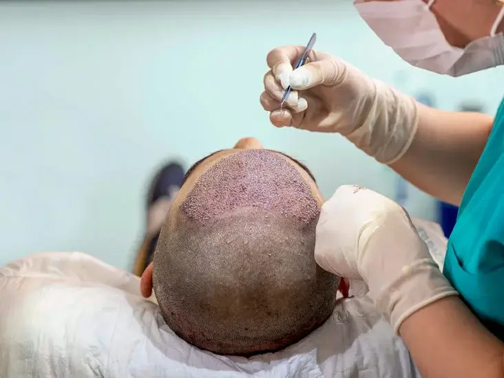 How Is Hair Transplant Done?
