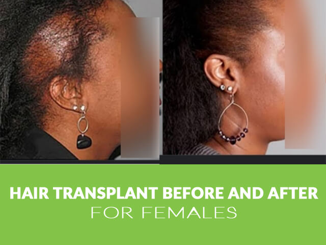 Hair transplant before and after female