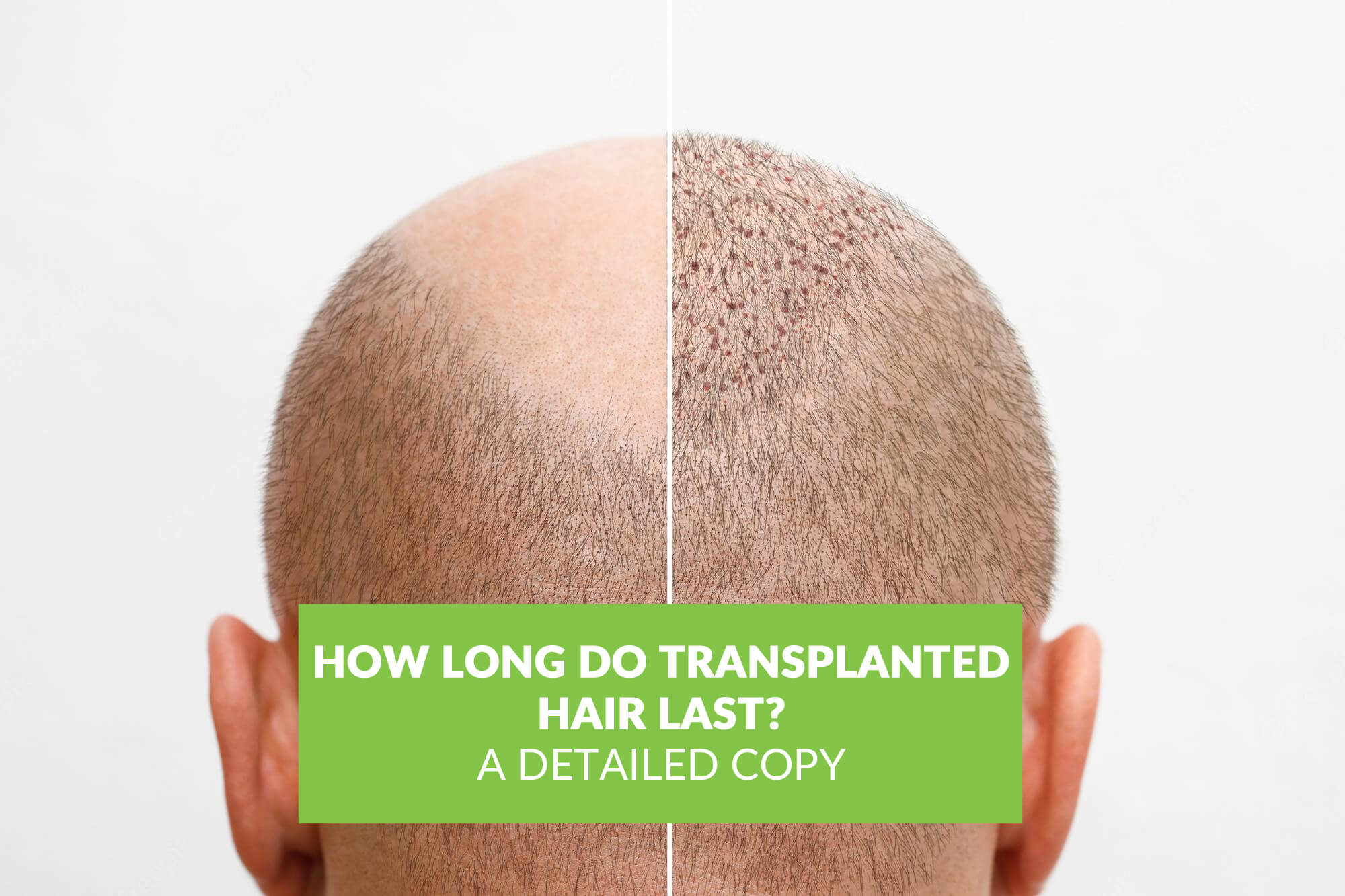 How Long Do Transplanted Hair Last: Is it Permanent?