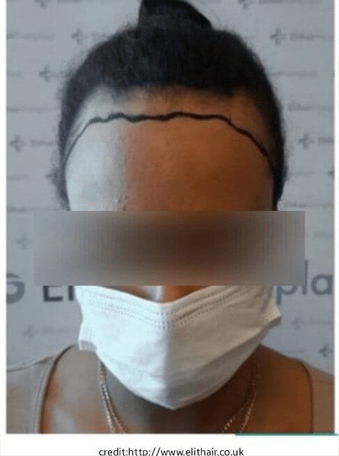 hair transplant before and after