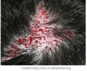 Bleeding from hair transplant surgery