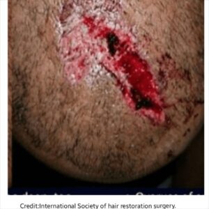 injuries from hair transplant