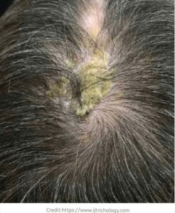 health complications from hair transplant