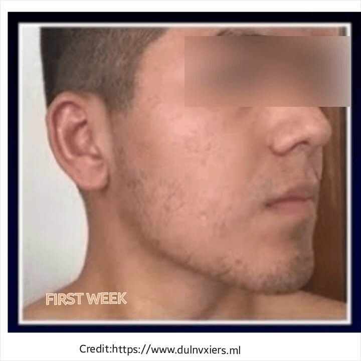 Derma Roller For Beard Before And After Do Derma Rollers Work for