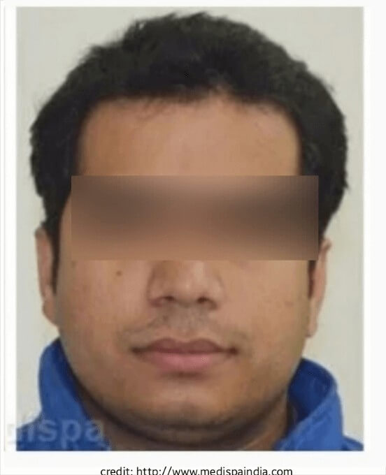 after hair transplant surgery