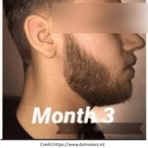 derma roller 3 months usage