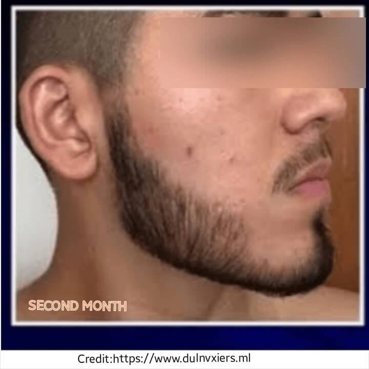 Derma Roller For Beard Before And After Do Derma Rollers Work for