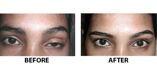 Hooded Eye Botox Eyebrow Lift: Everything You Need To Know