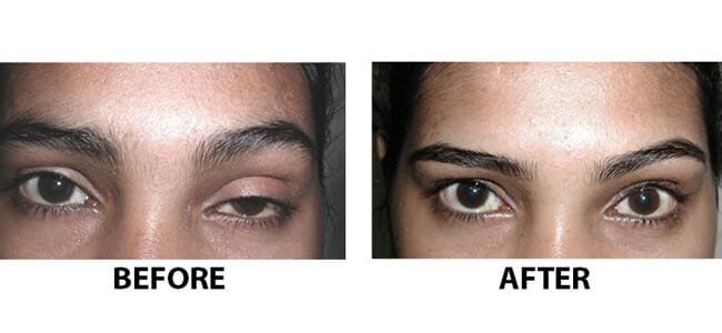 Hooded Eye Botox Eyebrow Lift