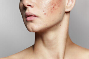 How to remove Acne scars naturally in a week