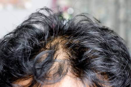 Oils For Thinning Hair