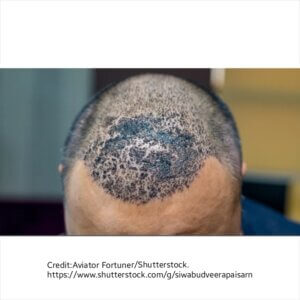 Infected scalp after hair transplant.