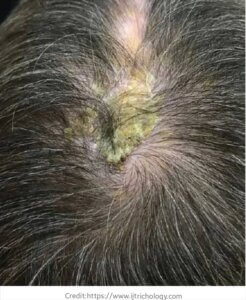 Infected scalp after hair transplantation.