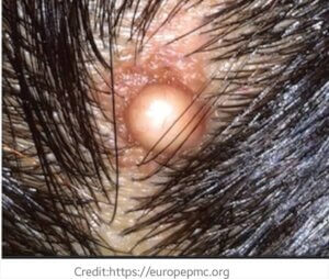 Infected scalp after hair transplantation.