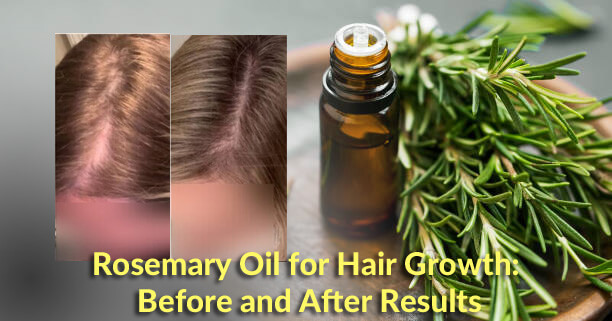 Rosemary Oil For Hair Growth Before And After