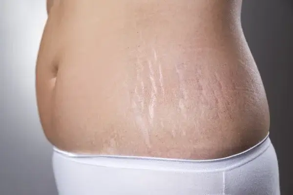 Skin tightening cream for stomach after weight loss