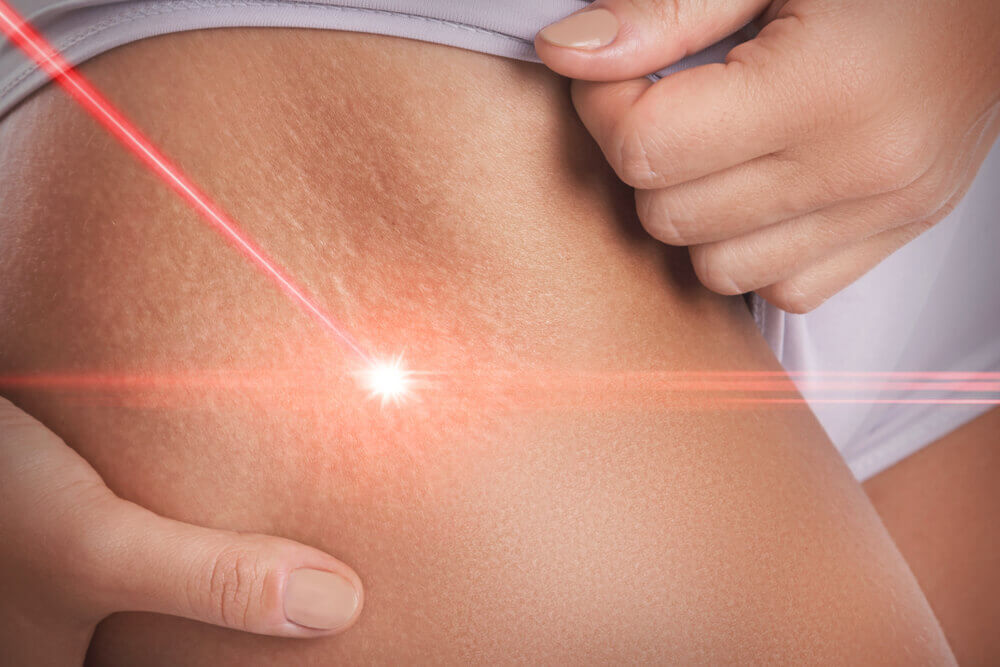 Does Laser Stretch Mark Removal Work