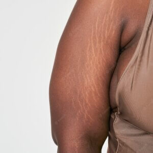 How to remove stretch marks permanently at home