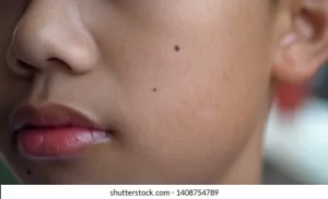How To Get Rid Of Flat Moles On Face Naturally