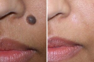How To Remove Moles From Face Naturally