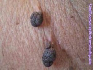 Skin tags